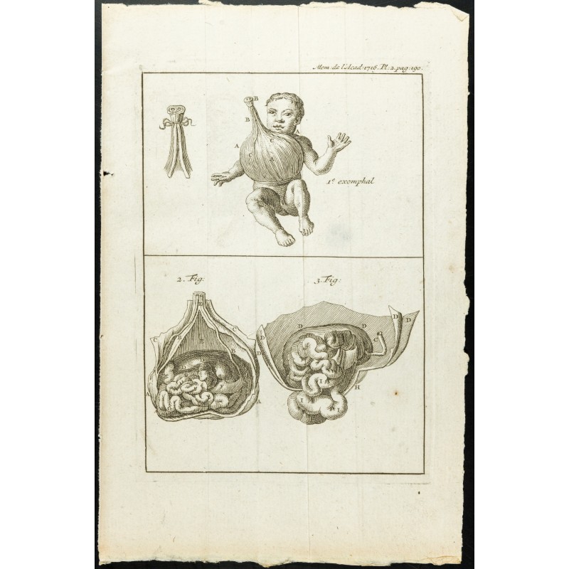 Gravure de 1777 - Hernie ombilicale Exomphale - 1