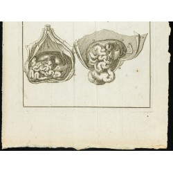 Gravure de 1777 - Hernie ombilicale Exomphale - 3