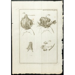 Gravure de 1777 - Hernie ombilicale Exomphale - 1