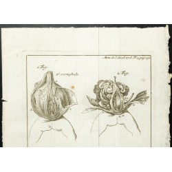 Gravure de 1777 - Hernie ombilicale Exomphale - 2