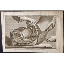 Gravure de 1781 - Chirurgie de l'abdomen - 1