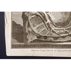 Gravure de 1781 - Chirurgie de l'abdomen - 4