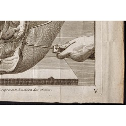 Gravure de 1781 - Chirurgie de l'abdomen - 5