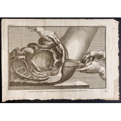 Gravure de 1781 - Chirurgie de la vessie - 1