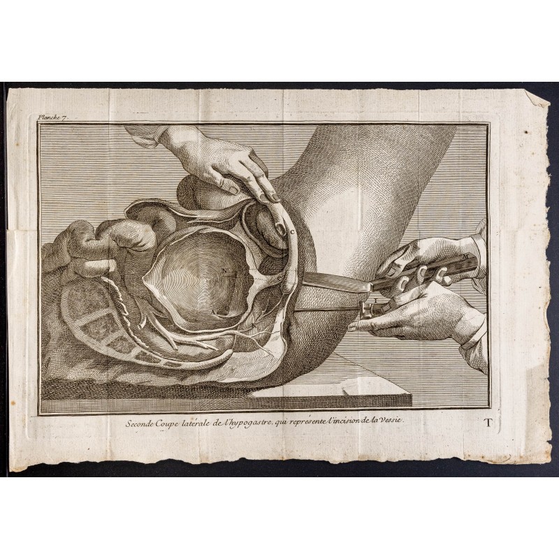 Gravure de 1781 - Chirurgie de la vessie - 1