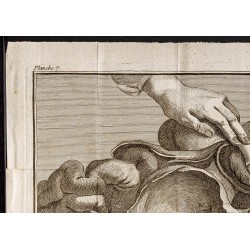 Gravure de 1781 - Chirurgie de la vessie - 2