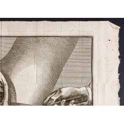 Gravure de 1781 - Chirurgie de la vessie - 3