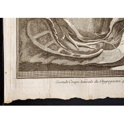 Gravure de 1781 - Chirurgie de la vessie - 4