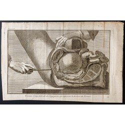 Gravure de 1781 - Chirurgie de l'abdomen - 1
