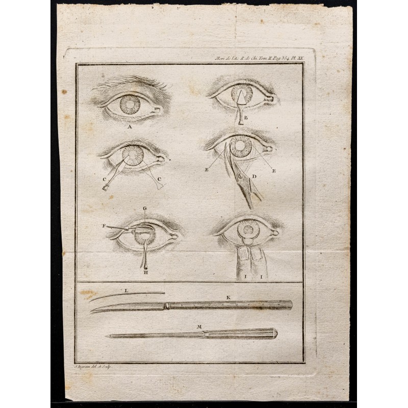 Gravure de 1787 - Chirurgie oculaire - 1