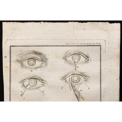 Gravure de 1787 - Chirurgie oculaire - 2