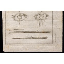 Gravure de 1787 - Chirurgie oculaire - 3