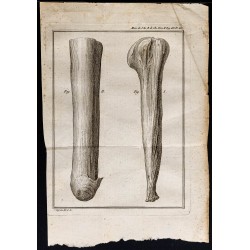 Gravure de 1787 - Moignon d'amputation - 1