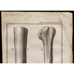 Gravure de 1787 - Moignon d'amputation - 2
