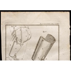 Gravure de 1787 - Machine à amputation de cuisse - 2