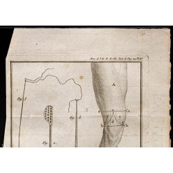 Gravure de 1787 - Instruments chirurgie - 2