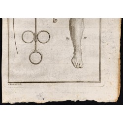 Gravure de 1787 - Instruments chirurgie - 3