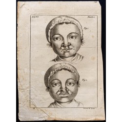 Gravure de 1781 - Becs de lièvre - 1