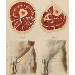 Gravure de 1846 - Coupe du bras, cuisse, jambe - 2