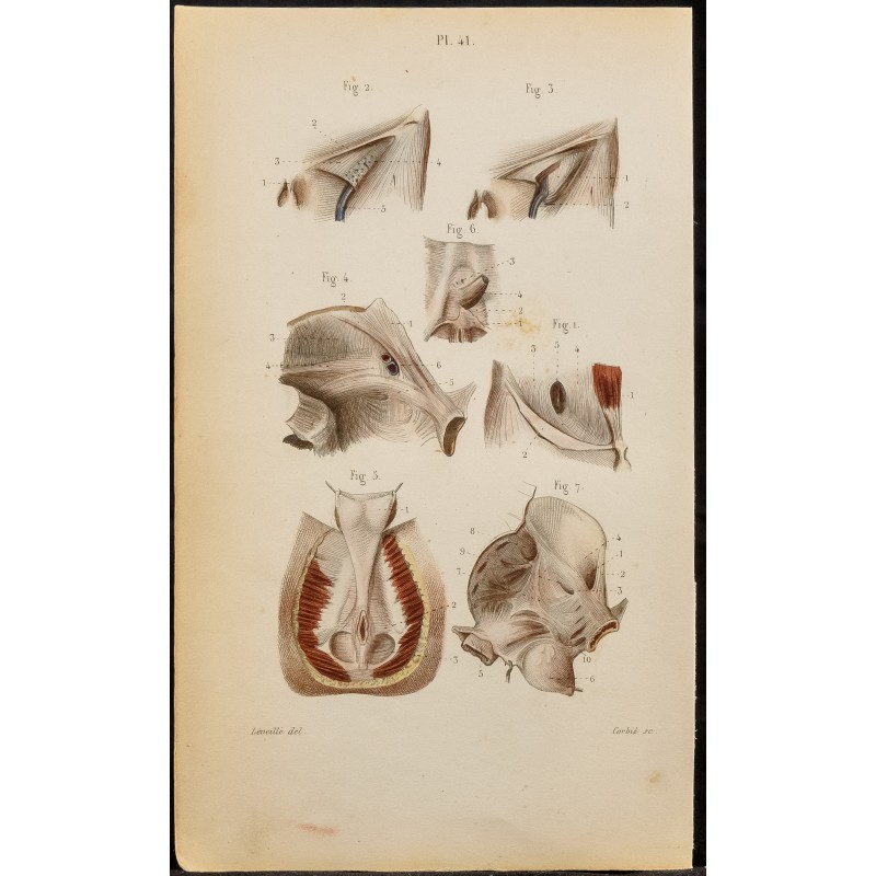 Gravure de 1846 - Aponévroses de l'aine, bassin, périnée - 1