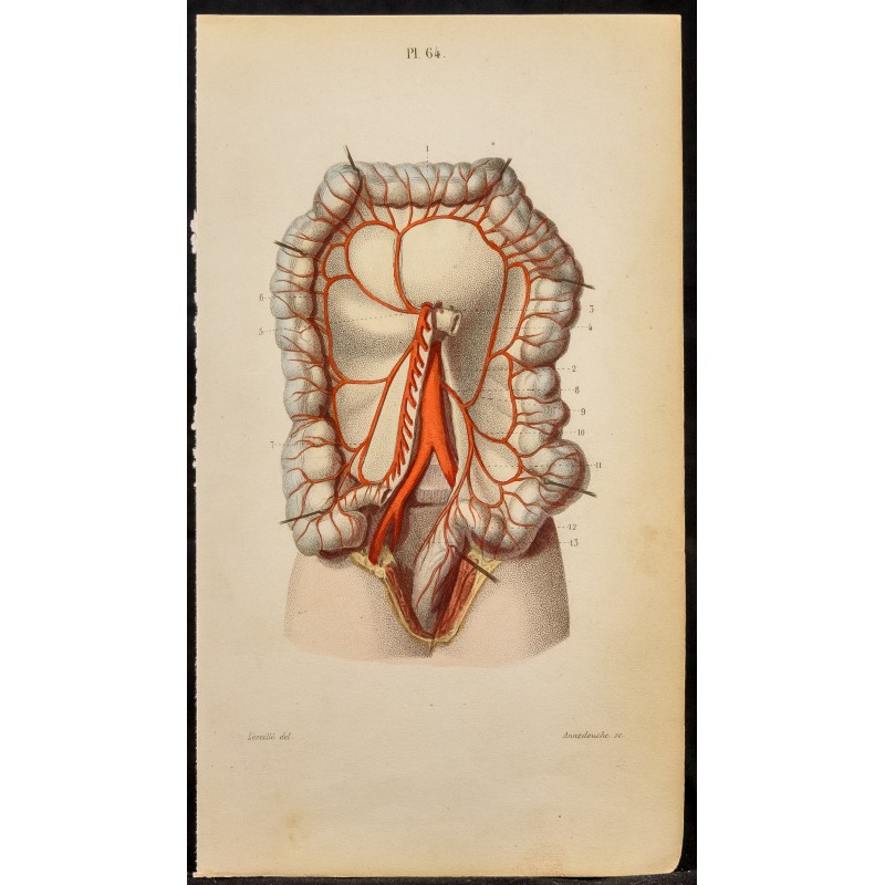 Gravure de 1846 - Artère mésentérique inférieure, coliques - 1