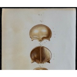 1852 - Os frontal et pariétal crâne 