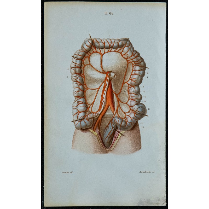 1852 - Artère mésentérique inférieure et coliques 