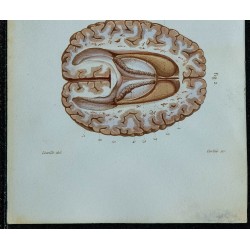 1852 - Corps calleux et plexus choroïdes 