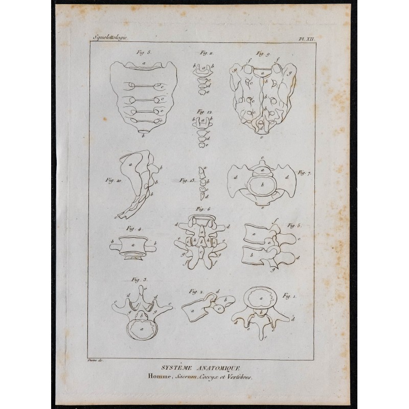 1825 - Sacrum, coccyx et vertèbres humaines 