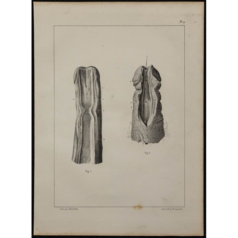 1839 - Urètre et verge incisée 