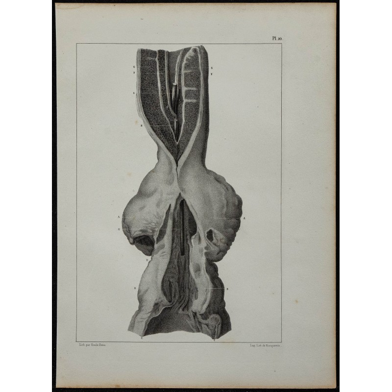 1839 - Urètre rétréci & prostate 
