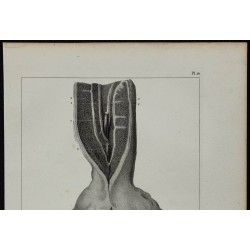 1839 - Urètre rétréci & prostate 