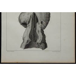 1839 - Urètre rétréci & prostate 