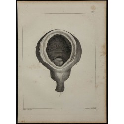 1839 - Prostate et vessie anormale 