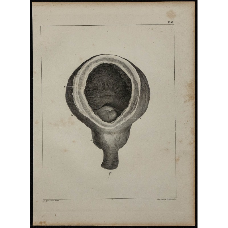 1839 - Prostate et vessie anormale 