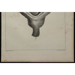 1839 - Prostate et vessie anormale 