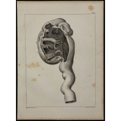 1839 - Rein pathologique dilaté 