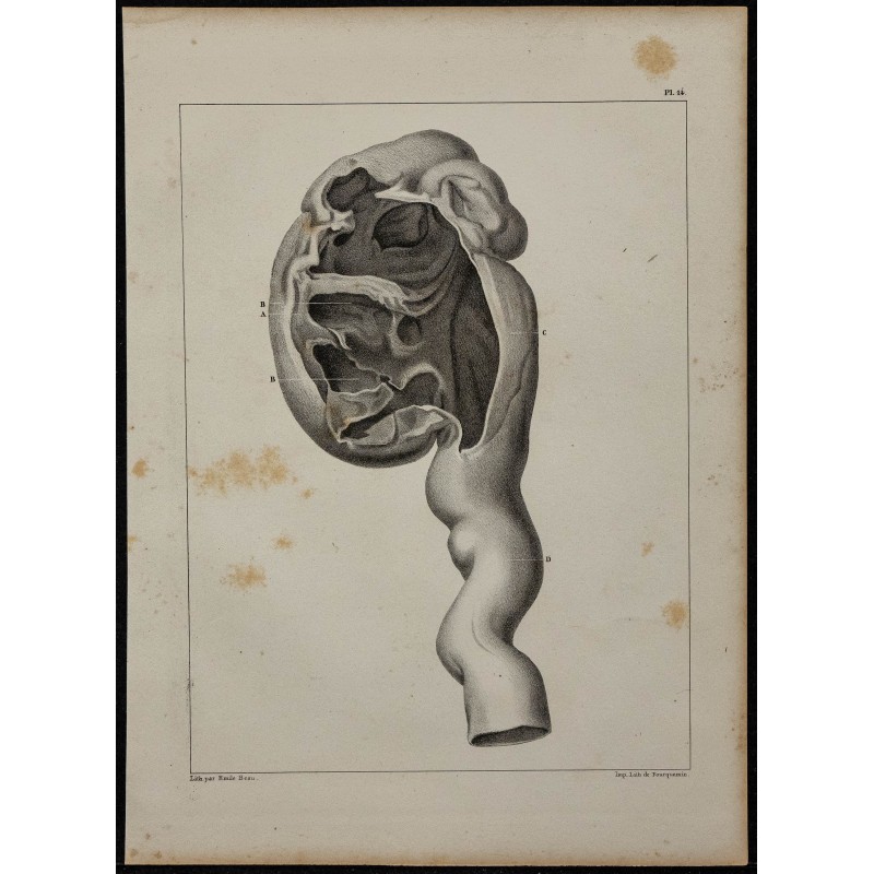 1839 - Rein pathologique dilaté 