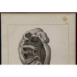 1839 - Rein pathologique dilaté 