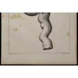 1839 - Rein pathologique dilaté 