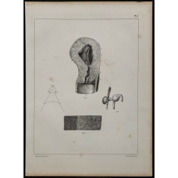 1839 - Utérus gravidique et anévrisme 