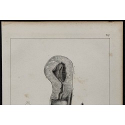 1839 - Utérus gravidique et anévrisme 