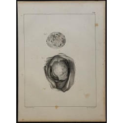 1839 - Testicule avec caillots 