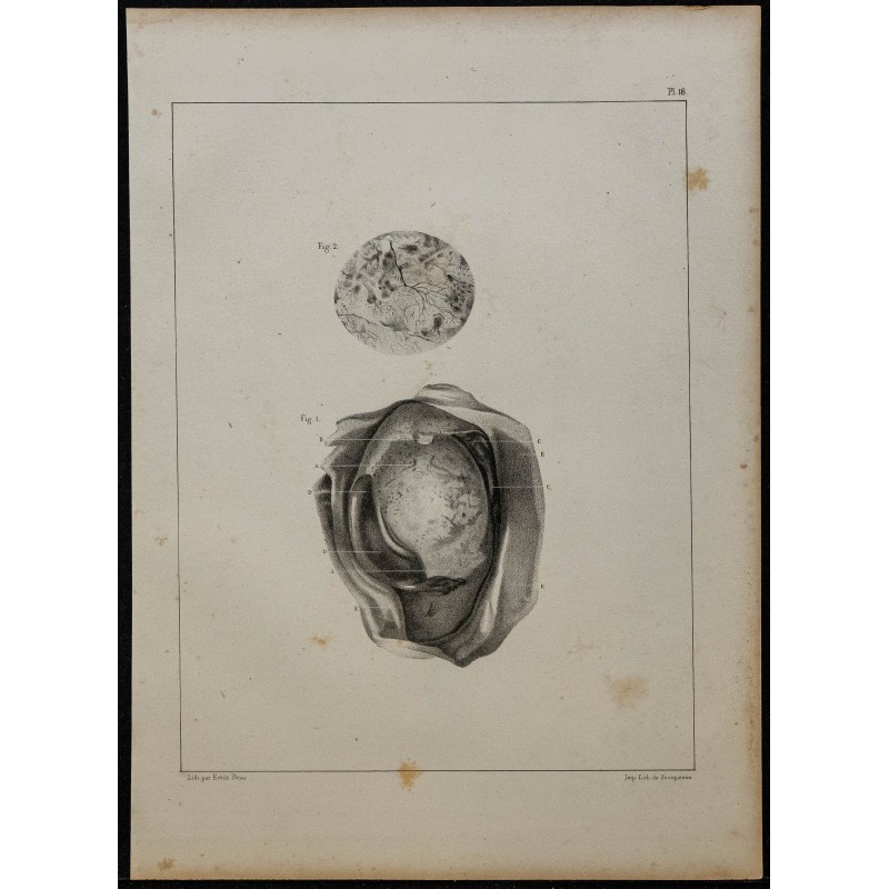 1839 - Testicule avec caillots 