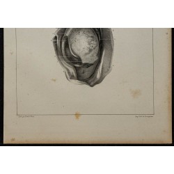 1839 - Testicule avec caillots 