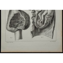 1839 - Anévrismes, articulations et intestin 