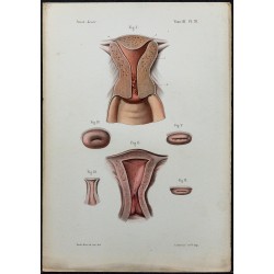 1866 - Utérus & col utérin 