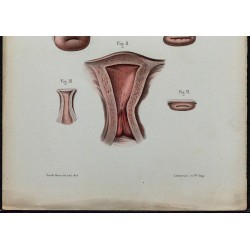 1866 - Utérus & col utérin 