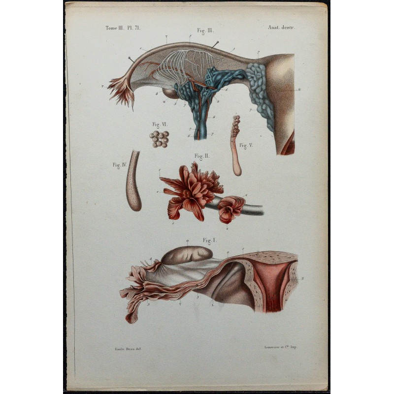 1866 - Trompe utérine & organe de Rosenmüller 