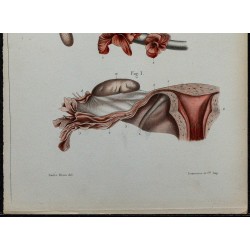 1866 - Trompe utérine & organe de Rosenmüller 